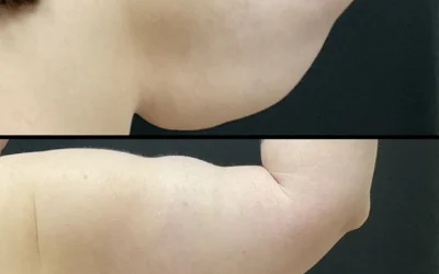 Rhinoplasty