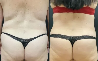 before and after liposuction