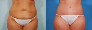 before and after liposuction