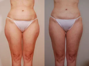 before and after liposuction