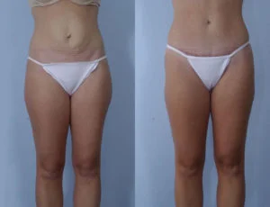 before and after liposuction
