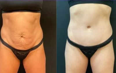 before and after tummy tuck