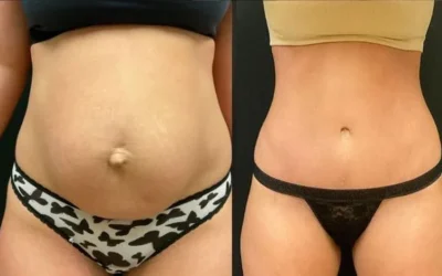 before and after tummy tuck