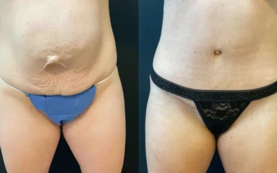 before and after tummy tuck