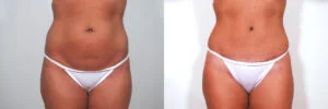 before and after tummy tuck