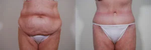 before and after tummy tuck